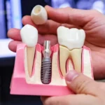 1747763880_pro-koho-jsou-vhodne-jednostupnove-zubni-implantaty.webp.webp